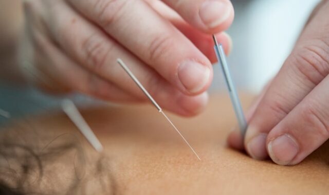 Acupuncture alcool