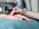acupuncture